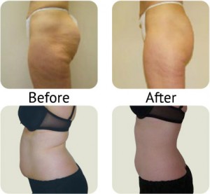 Lipofirm Plus - before and after